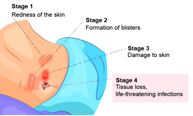 Bed sore pictures of stages 1 - 4, showing life-threatening infections for stage 4 bedsores