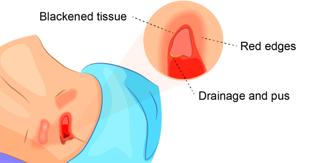A graphic showing the symptoms of stage 3 bedsores. Common symptoms include visible wound depth, blackened tissue, red edges, drainage, and pus.