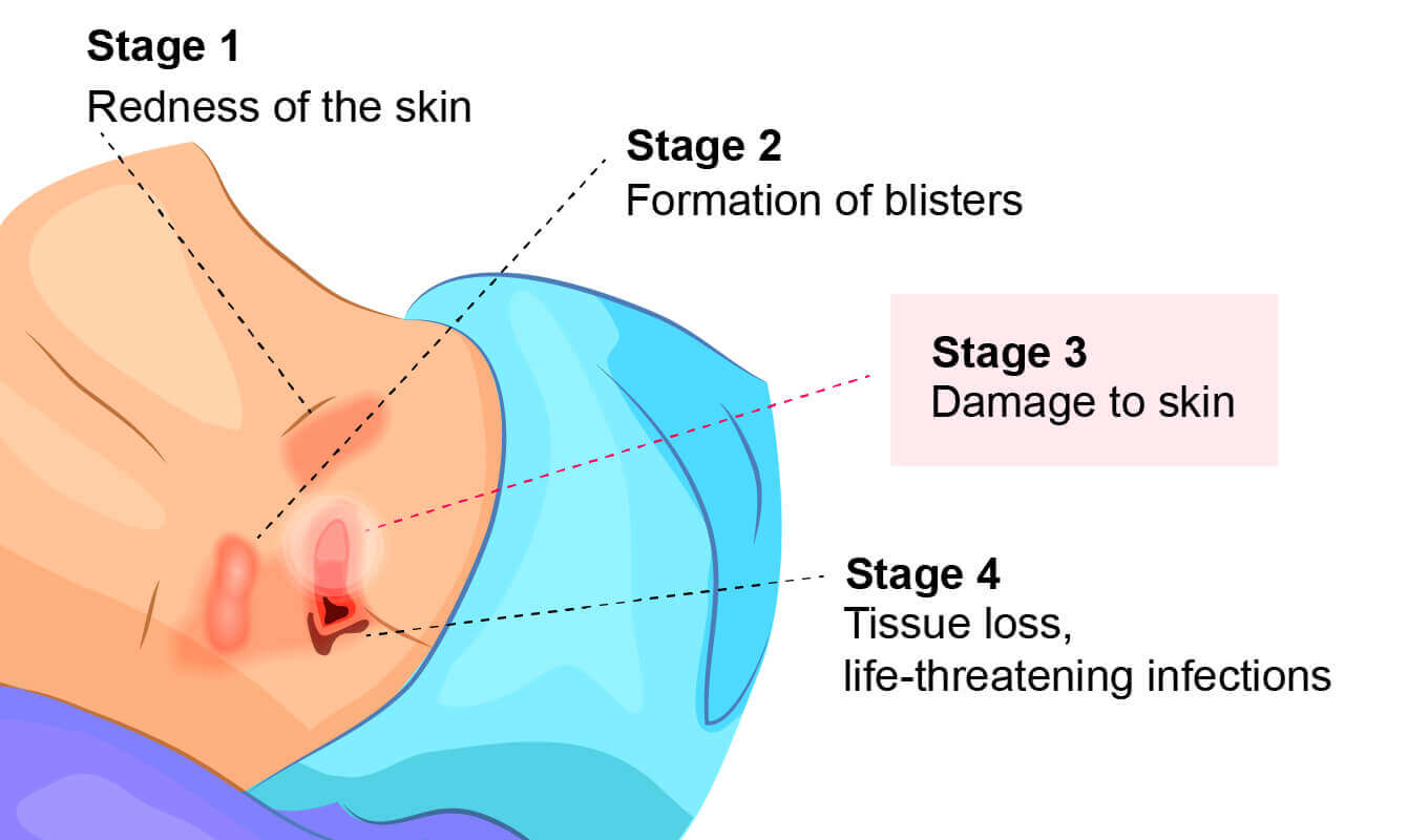 A graphic showing the four stages of bedsores. Stage 3 bedsores cause full-thickness skin loss.